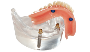 2-locators-with-removable-bar-overdenture